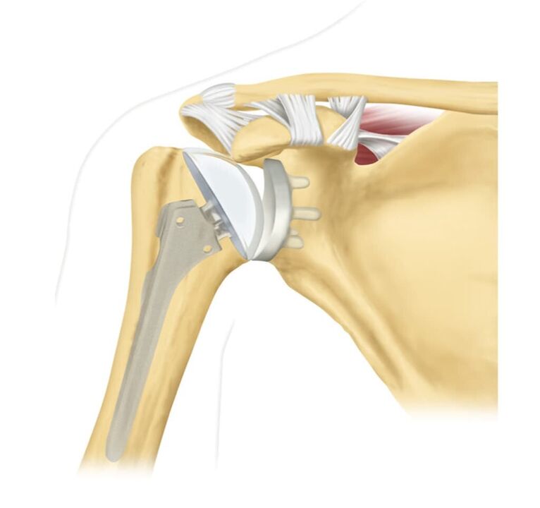Náhrada poškodeného ramenného kĺbu endoprotézou
