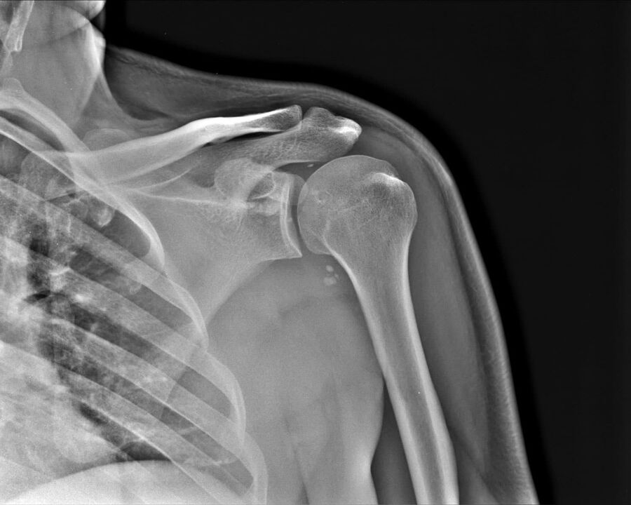 RTG artrózy ramenného kĺbu 2. stupňa závažnosti