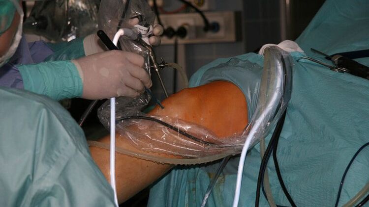 chirurgická liečba artrózy