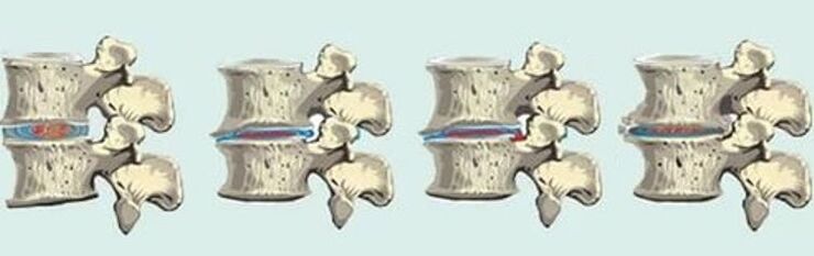 lézie chrbtice v prípade hrudnej osteochondrózy