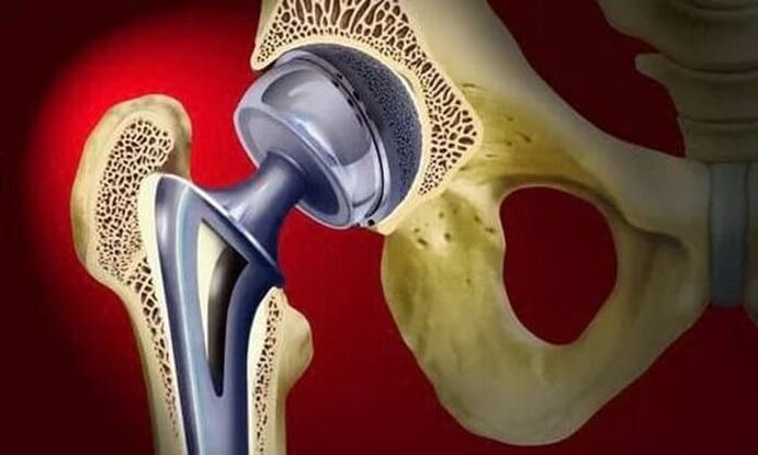 náhrada bedrového kĺbu pri artróze