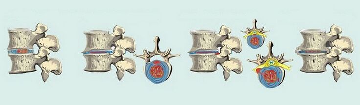 Etapy vzniku osteochondrózy chrbtice