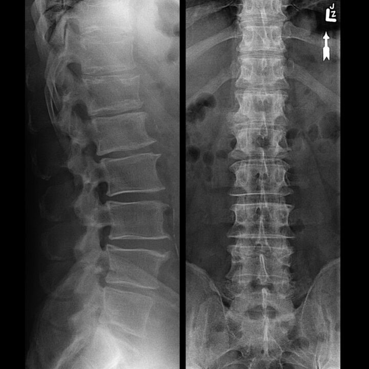 Röntgenový snímok hrudnej oblasti, ktorý ukazuje zmenšenie medzery medzi stavcami pozdĺž chrbtice zdola nahor
