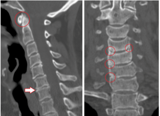 CT vyšetrenie ukazuje poškodené stavce a platničky heterogénnej výšky v dôsledku hrudnej osteochondrózy
