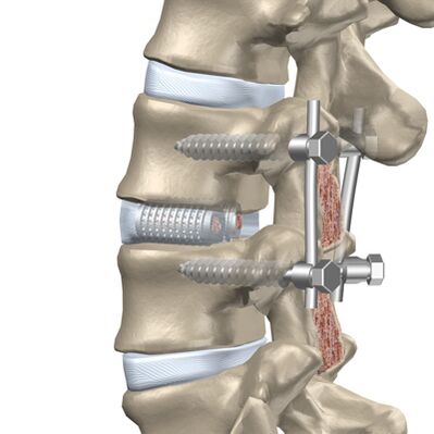 Náhrada zničenej platničky hrudnej chrbtice umelým implantátom