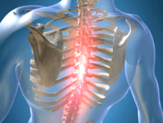 Opakujúca sa alebo pretrvávajúca bolesť pri osteochondróze hrudníka