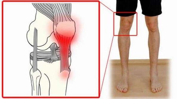 poškodenie kĺbov pri artróze ramena