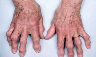 ako odlíšiť artritídu prstov od artrózy