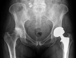 diagnostika artrózy bedrového kĺbu