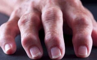 reumatoidná artritída ako príčina bolesti kĺbov